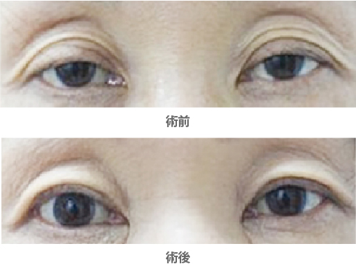 「腱膜性眼瞼下垂・挙筋腱膜短縮法（保険適用）」の症例写真・ビフォーアフター