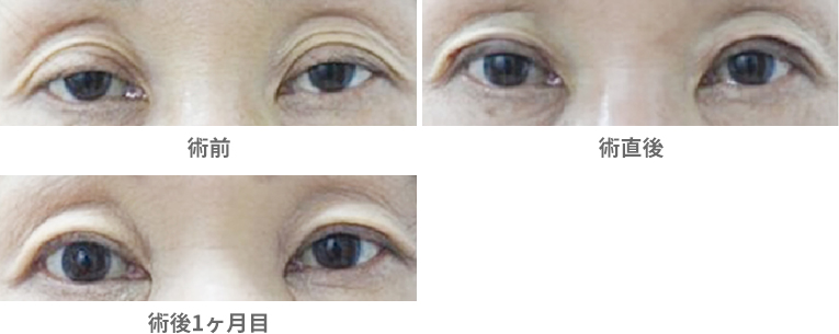 「腱膜性眼瞼下垂・挙筋腱膜短縮法（保険適用）」の症例写真・ビフォーアフター