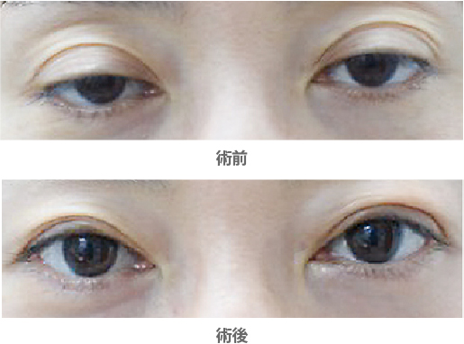 「後天性眼瞼下垂・腱膜前転法（保険適用）」の症例写真・ビフォーアフター