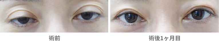 「後天性眼瞼下垂・腱膜前転法（保険適用）」の症例写真・ビフォーアフター