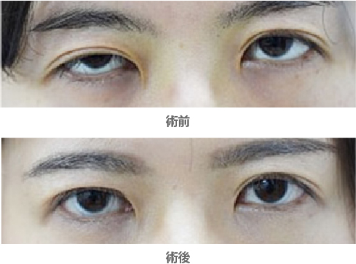 「先天性眼瞼下垂・腱膜前転法（保険適用）」の症例写真・ビフォーアフター