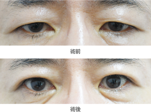 「眼瞼下垂・挙筋腱膜前転法（保険適用／二重を目立たせない仕上がりに）」の症例写真・ビフォーアフター