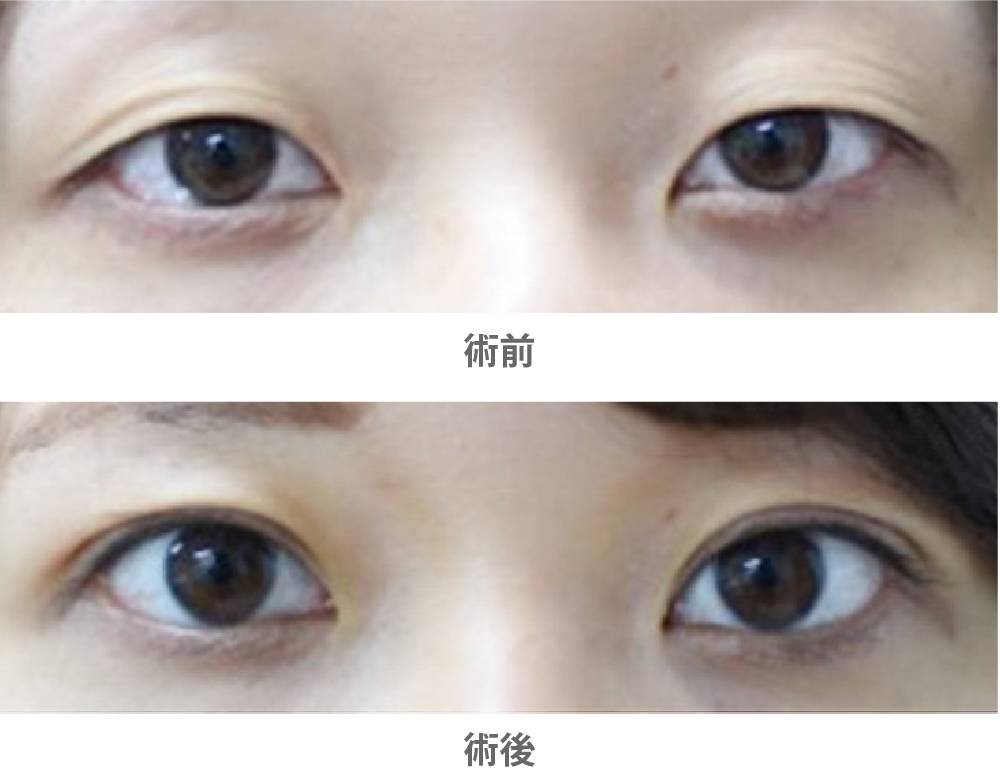 目が大きく見える
