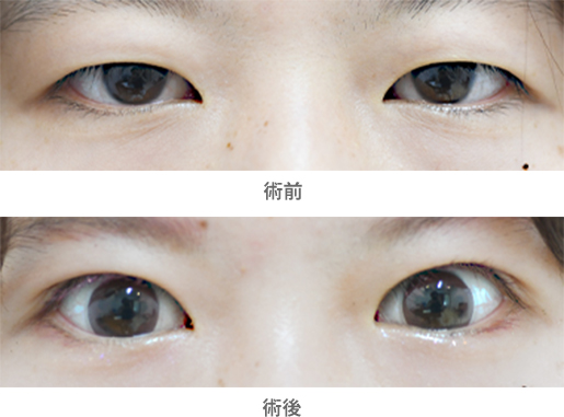 「目ヂカラアップに重点を置いた二重切開術（眼瞼下垂手術併用）」の症例写真・ビフォーアフター