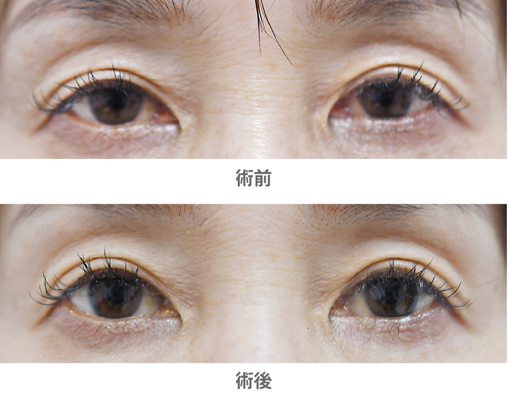 「アップニーク点眼（切らない眼瞼下垂治療）」の症例写真・ビフォーアフター