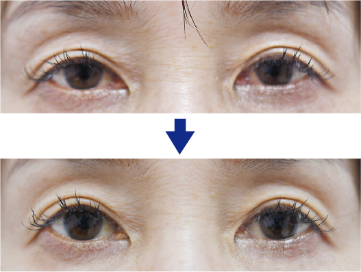 点眼による眼瞼下垂治療アップニークによる症例