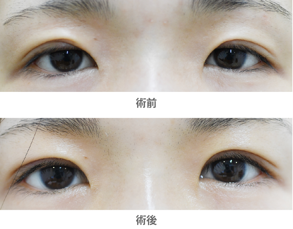 目上切開