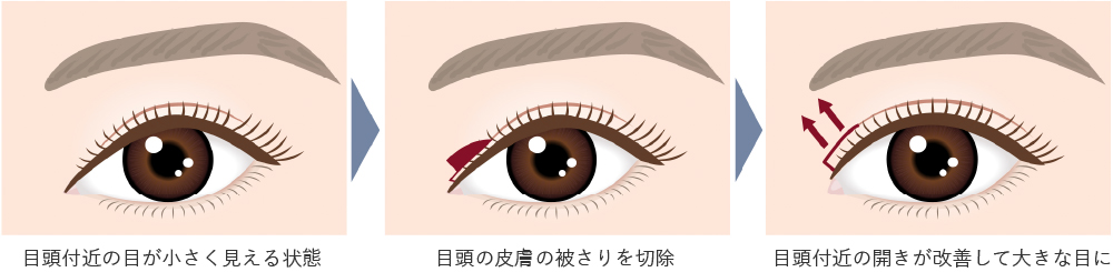 目上切開とは