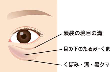 アイスレッドの適応について