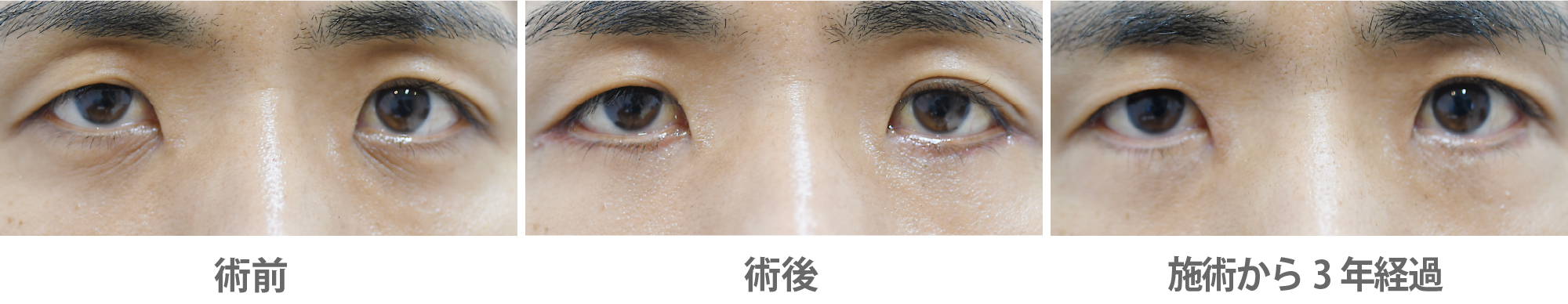 「目の下のたるみ・クマ取り（皮膚切除法）」の症例写真・ビフォーアフター