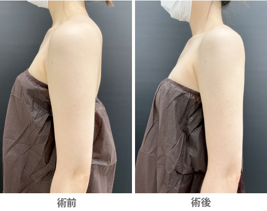 「カベリン注射（脂肪溶解注射）による二の腕痩せ」の症例写真・ビフォーアフター