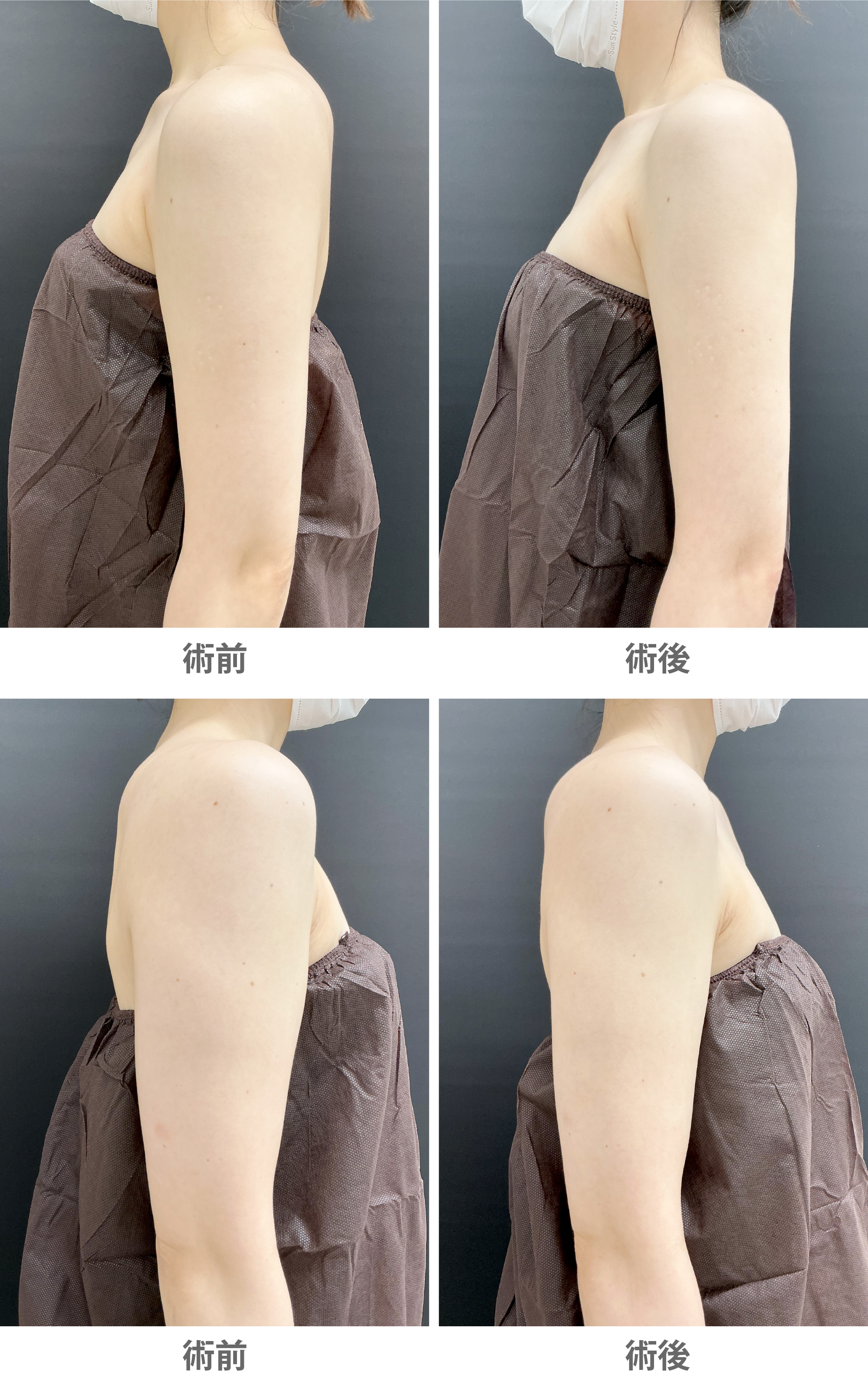 「カベリン注射（脂肪溶解注射）による二の腕痩せ」の症例写真・ビフォーアフター