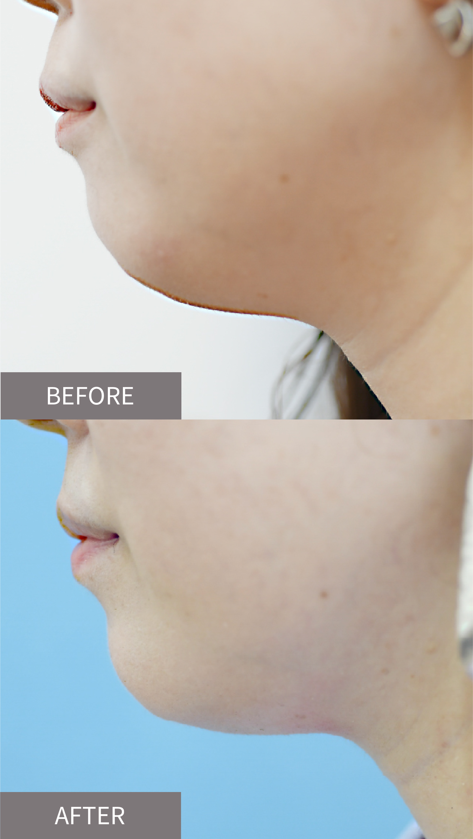 カベリン注射の施術変化