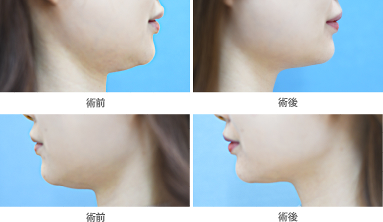 「舌下腺ボトックスによる小顔整形（顎下／舌下腺）」の症例写真・ビフォーアフター