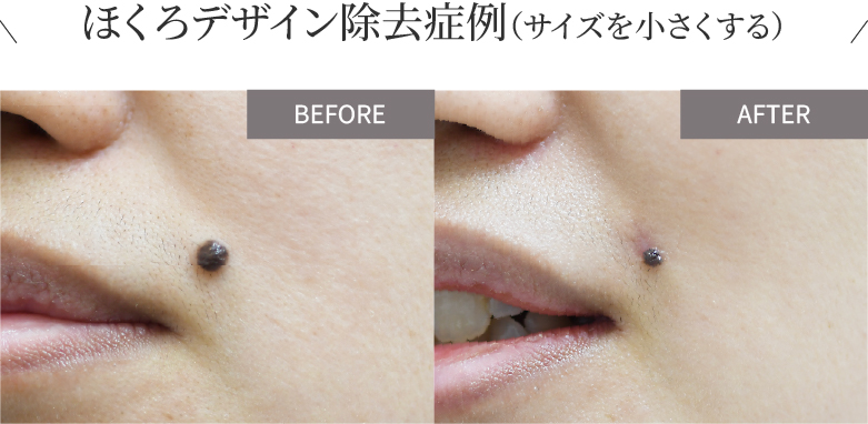 ほくろデザイン除去症例（サイズを小さくする）