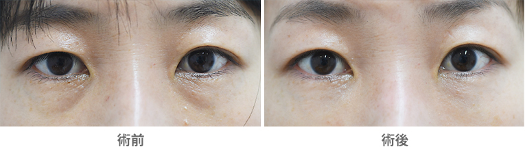 「目の下（下まぶた）クマ改善治療（ヒアルロン酸注入）」の症例写真・ビフォーアフター