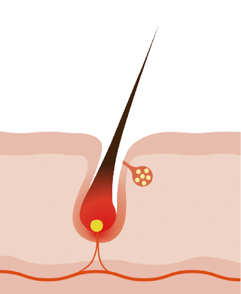 毛根部分の発毛組織が破壊されます。