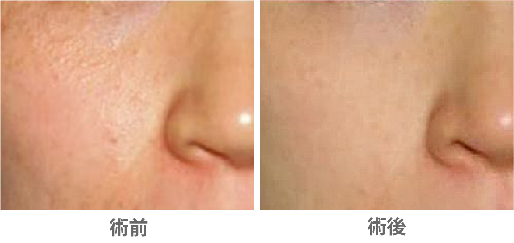 アグネスによる汗管腫治療の症例