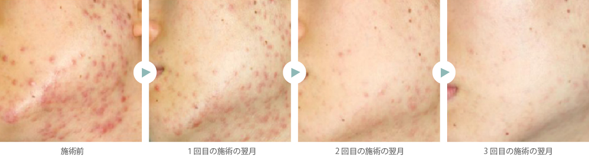 アグネスによるニキビ治療の経過例