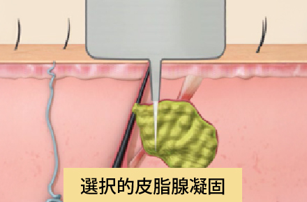 永久脱毛の原理を転用したニキビ治療