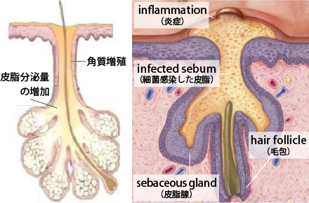 まずはニキビができる原理を理解する