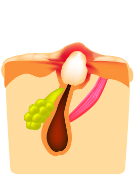 ②炎症性ニキビの排膿を促進