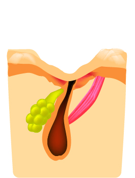 ①＋②の作用でニキビを改善します