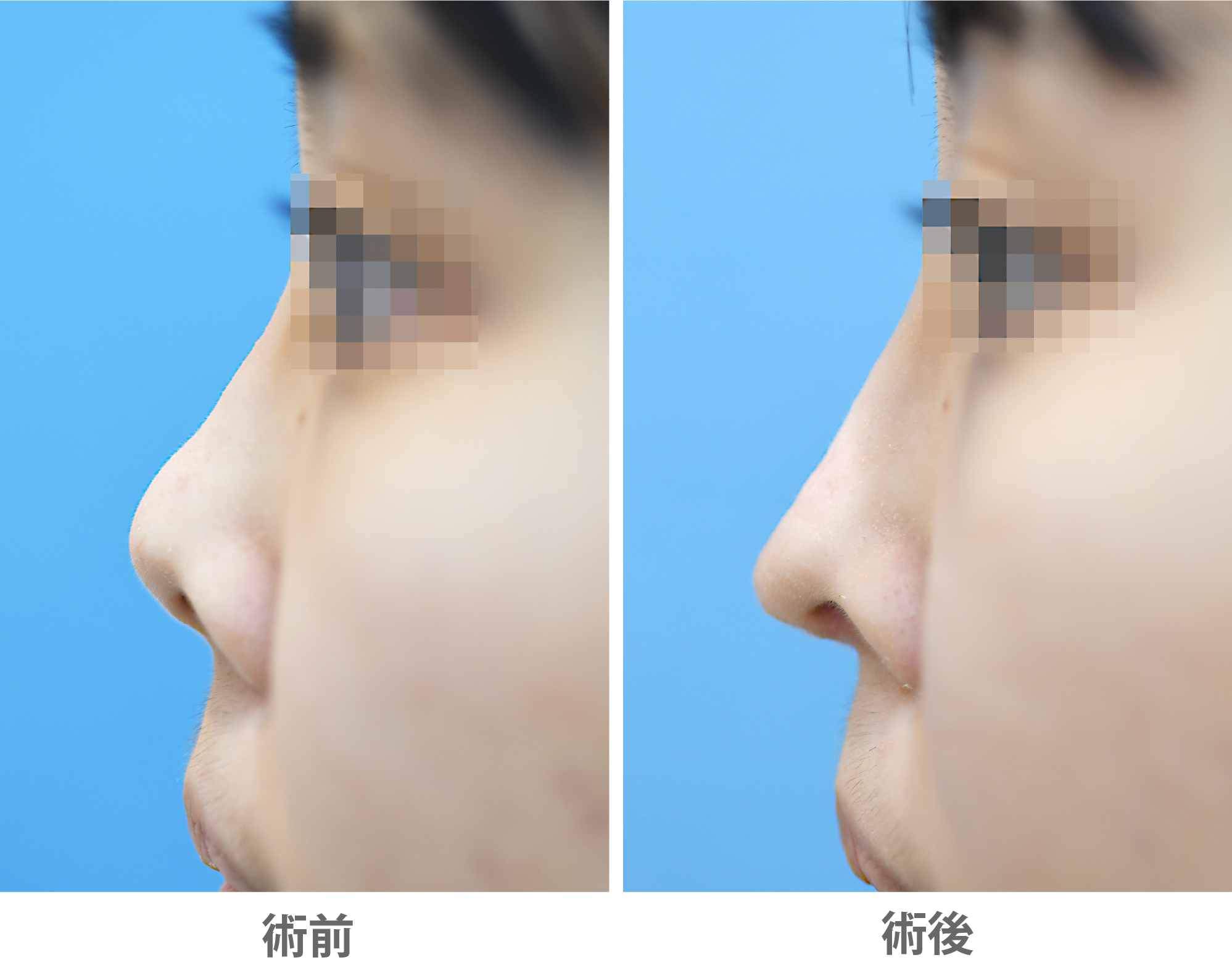 「鼻中隔延長術（ぶた鼻改善・尖り感のある鼻先に）」の症例写真・ビフォーアフター