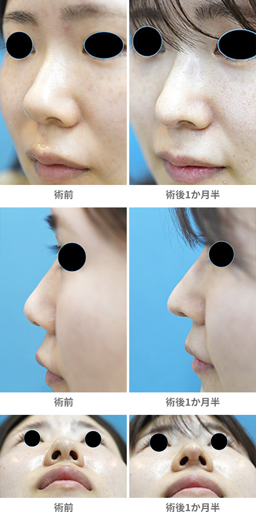 「鼻中隔延長術・鼻尖修正(短鼻の改善)」の症例写真・ビフォーアフター