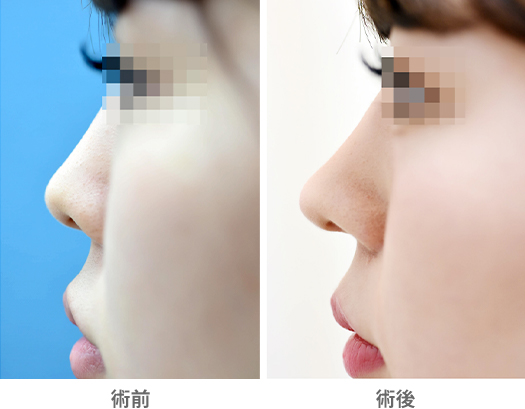「鼻中隔延長術（単独手術）」の症例写真・ビフォーアフター