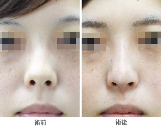 鼻孔縁下降術＋鼻中隔延長術（鼻の穴を目立たなくするコンビ手術）