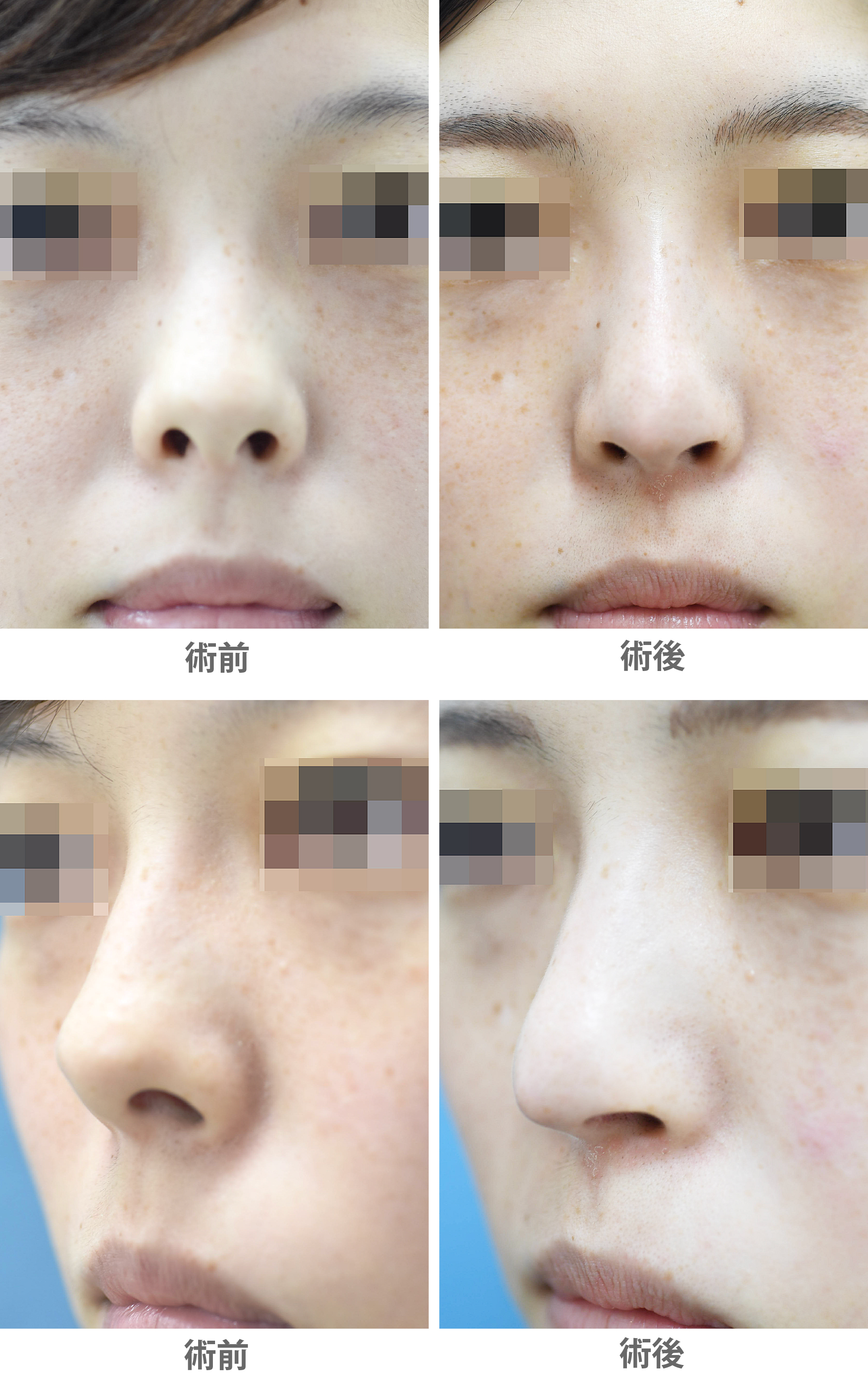 「鼻孔縁下降術＋鼻中隔延長術（鼻の穴を目立たなくするコンビ手術）」の症例写真・ビフォーアフター