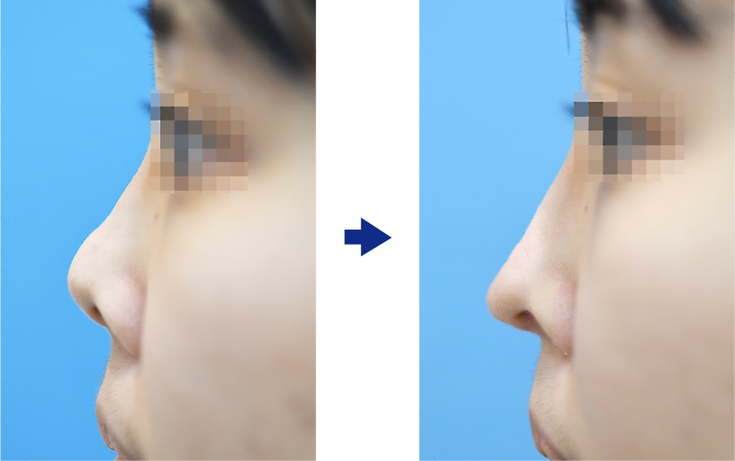 鼻中隔延長術によるぶた鼻改善（尖り感のある鼻先に）