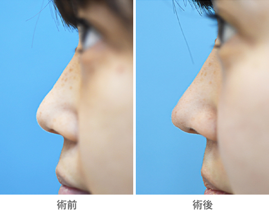 「鼻尖耳介軟骨移植（クイック法／クローズドアプローチ）」の症例写真・ビフォーアフター