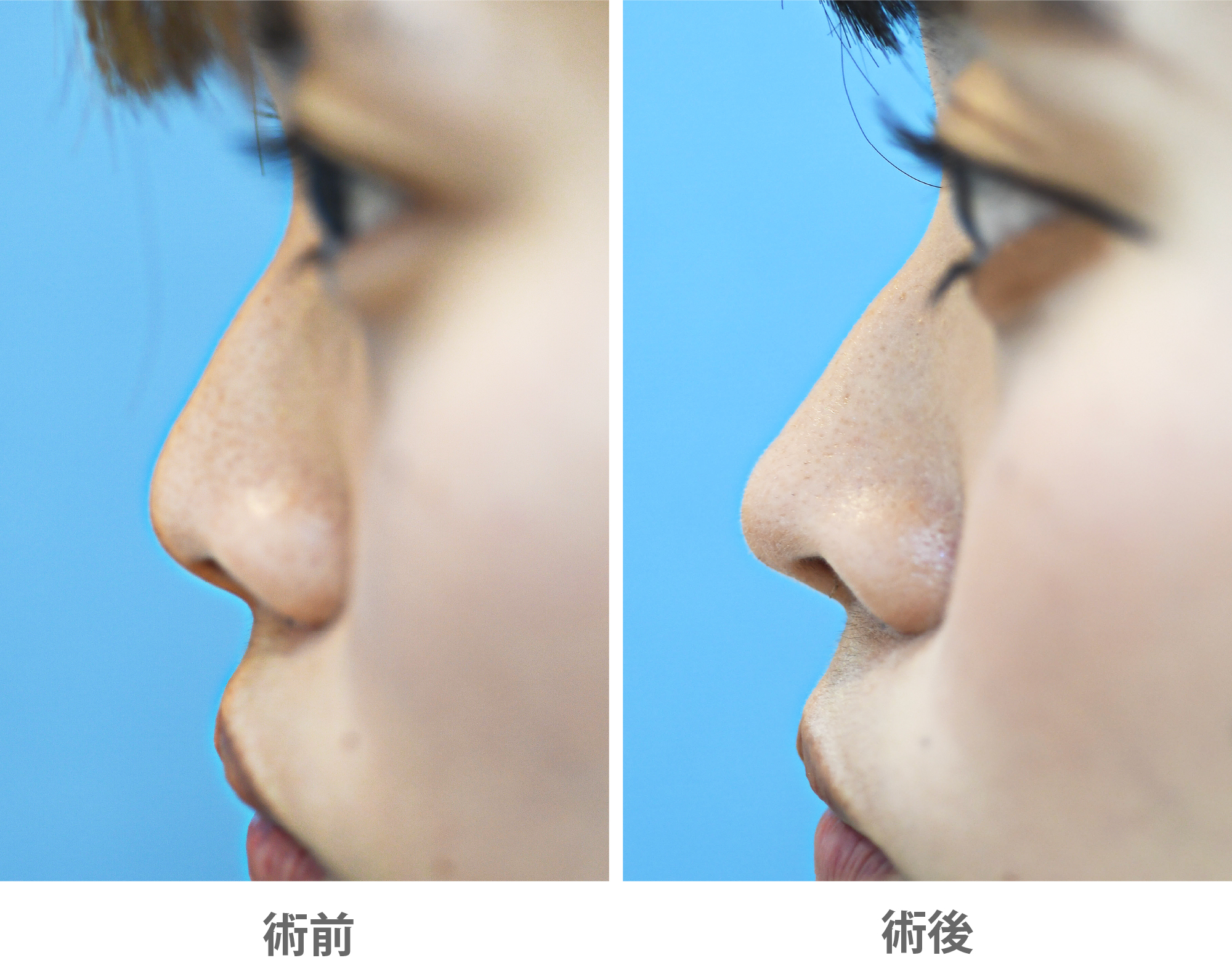 「鼻尖耳介軟骨移植（クローズ法）」の症例写真・ビフォーアフター