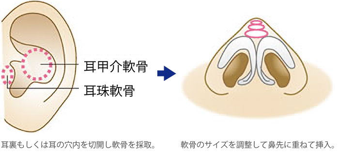 鼻尖耳介軟骨移植の施術イメージ
