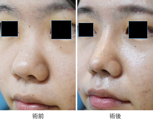 「鼻尖修正（太い鼻を全体的に細くする）」の症例写真・ビフォーアフター