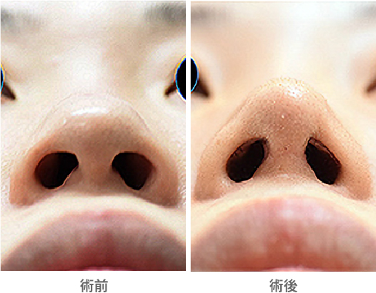 「鼻尖形成」の症例写真・ビフォーアフター