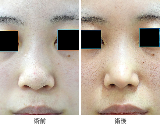 「鼻尖修正（鼻先を違和感のない自然な形で細くする）」の症例写真・ビフォーアフター