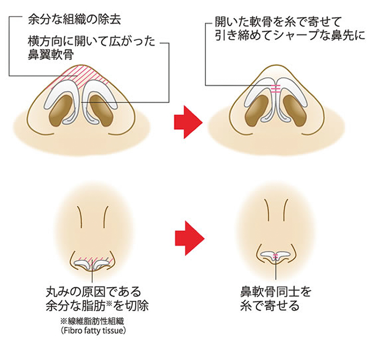 鼻尖縮小(鼻尖形成・鼻尖修正)の整形術について