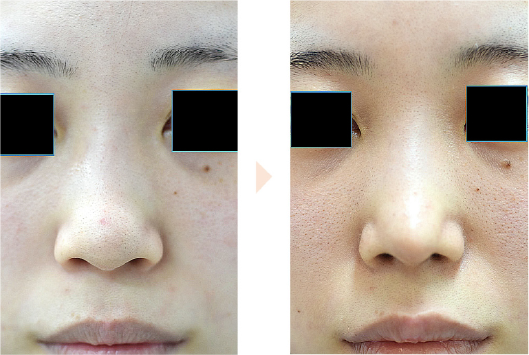 太い(丸い)鼻先を目立たなくする