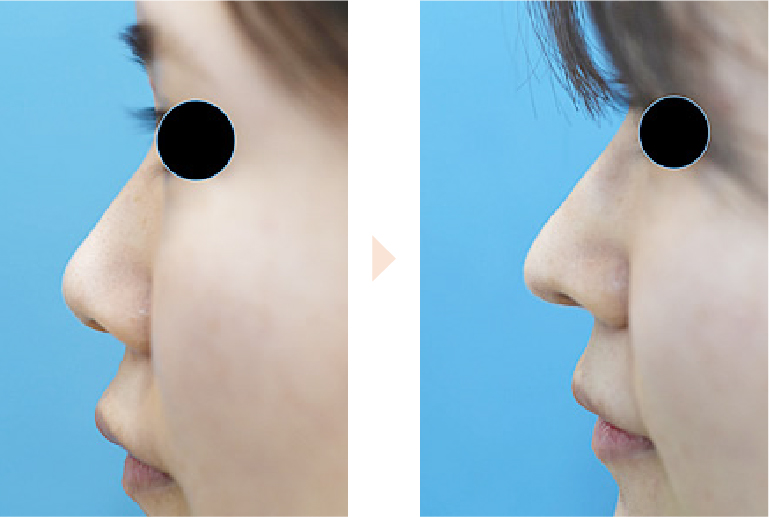 低い鼻先に高さを出す