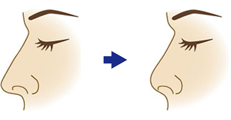 高すぎる鼻を調整する