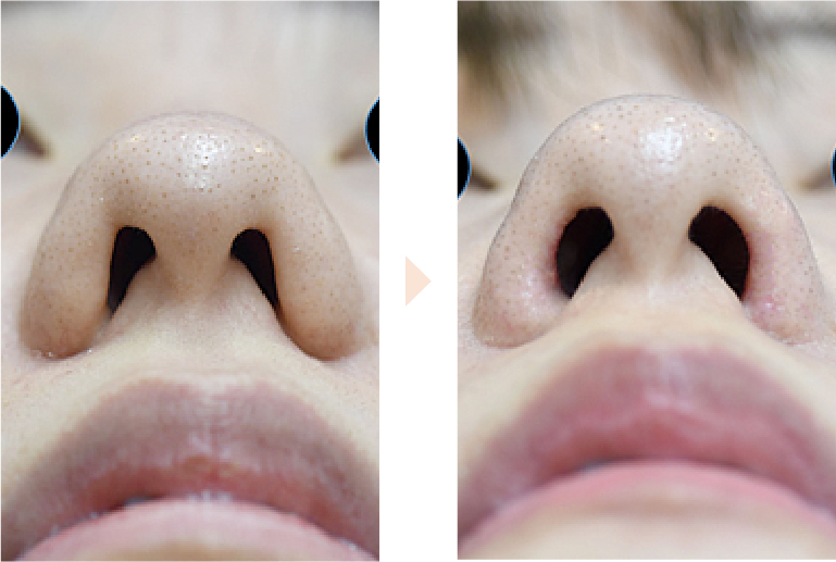 分厚い鼻翼を薄くする