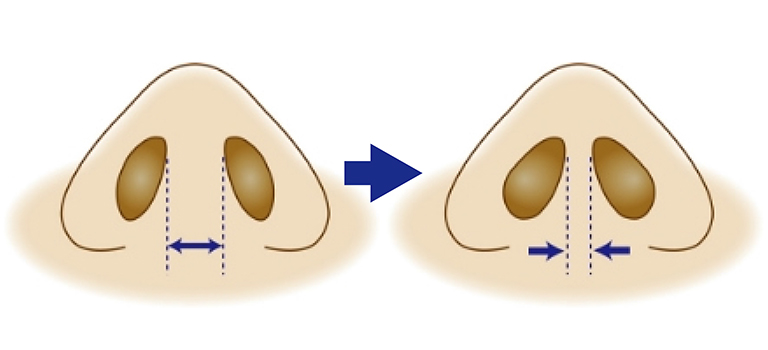 厚みのある鼻柱を薄くする