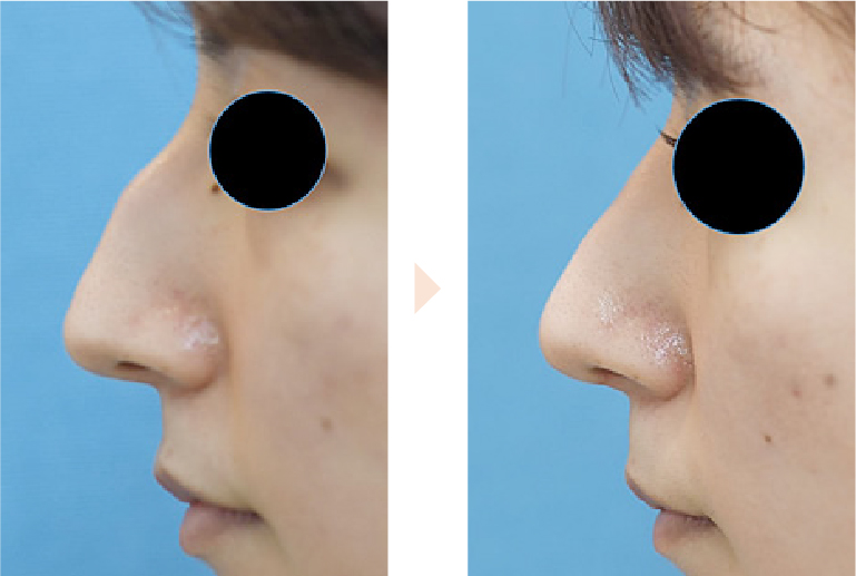 前方に出た鼻スジを改善する