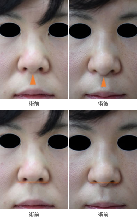「鼻橋部耳介軟骨移植（鼻柱下降、鼻柱延長／クローズ法）」の症例写真・ビフォーアフター
