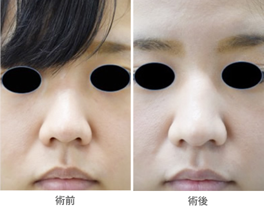「鼻柱下降術（鼻橋部耳介軟骨移植・鼻柱延長／クローズ法）」の症例写真・ビフォーアフター