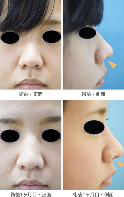 「鼻橋部耳介軟骨移植（鼻柱下降、鼻柱延長）」の症例写真・ビフォーアフター