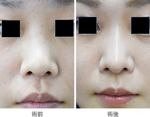 「鼻橋部耳介軟骨移植（鼻柱下降、鼻柱延長／クローズ法）」の症例写真・ビフォーアフター